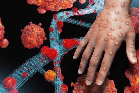 ОСПА ОБЕЗЬЯН